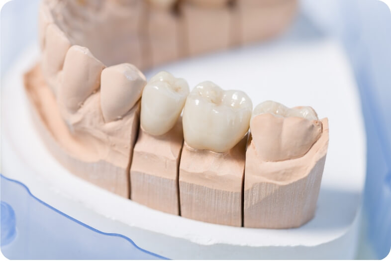 虫歯の再発のリスクが低い