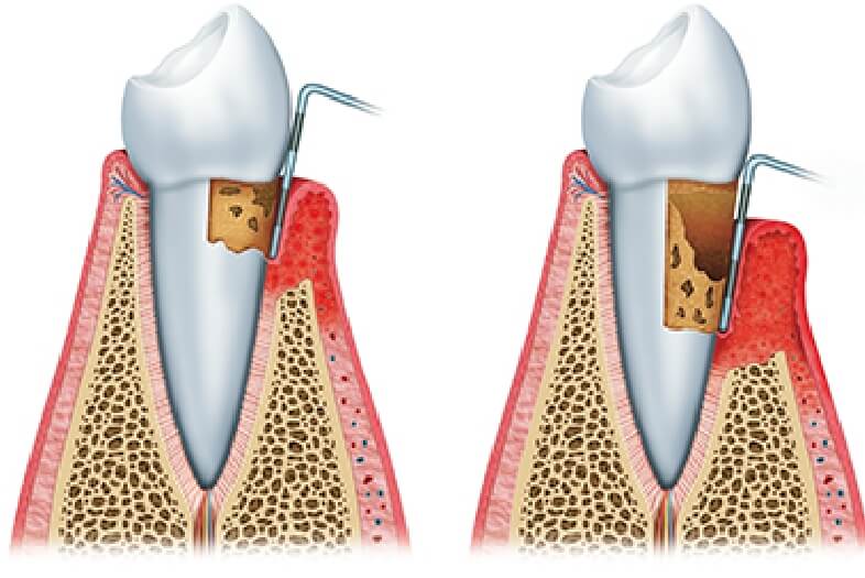 虫歯と歯周病の原因